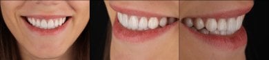 Преображение улыбки с винирами в RIKOTA Dental Clinic – естественный результат