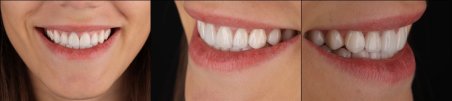 Преображение улыбки с винирами в RIKOTA Dental Clinic – естественный результат