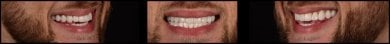 Преображение улыбки винирами в RIKOTA Dental Clinic – естественный результат