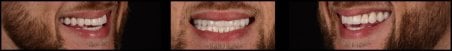 Преображение улыбки винирами в RIKOTA Dental Clinic – естественный результат