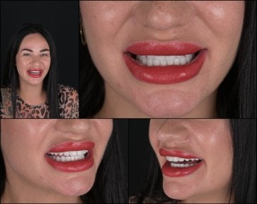 Преображение улыбки с винирами в RIKOTA Dental Clinic – естественный результат