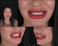 Преображение улыбки с винирами в RIKOTA Dental Clinic – естественный результат