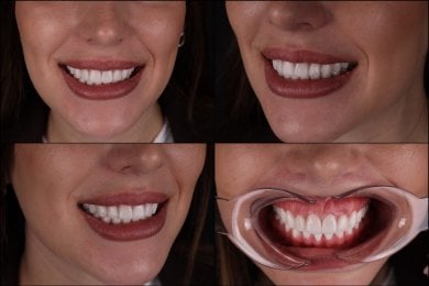 Преображение улыбки с винирами в клинике RIKOTA Dental Clinic, естественный результат