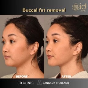 Before and after buccal fat removal result at ID Clinic Bangkok, slimmer facial contour