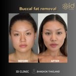 Before and after buccal fat removal results at ID Clinic Bangkok, slimmer facial contour