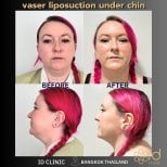 Результати VASER ліпосакції підборіддя в ID Clinic Bangkok, чіткіший контур обличчя