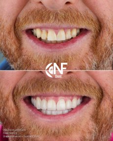 before-after photo dental-crown-installation