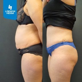 before-after photo liposuction