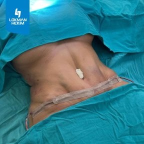 before-after photo liposuction