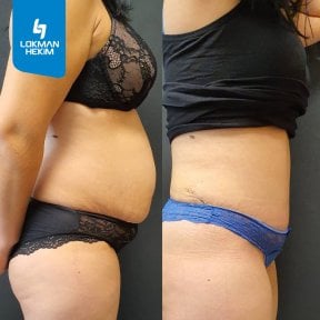 before-after photo liposuction