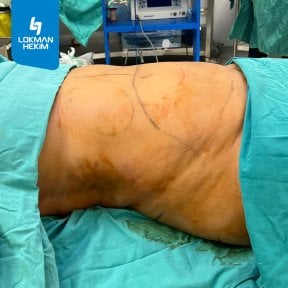 before-after photo liposuction
