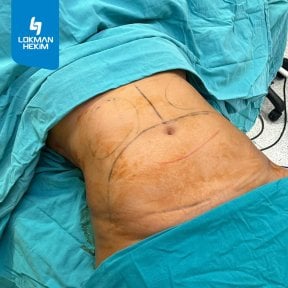before-after photo liposuction