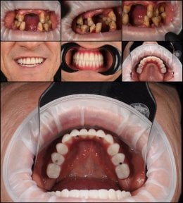before-after photo implantaciya-zubov-po-tehnologii-all-on-6--vse-na-chetureh
