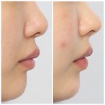 نتائج تجميل الأنف قبل وبعد في Retmus Plastic Surgery، تحسين شكل الأنف
