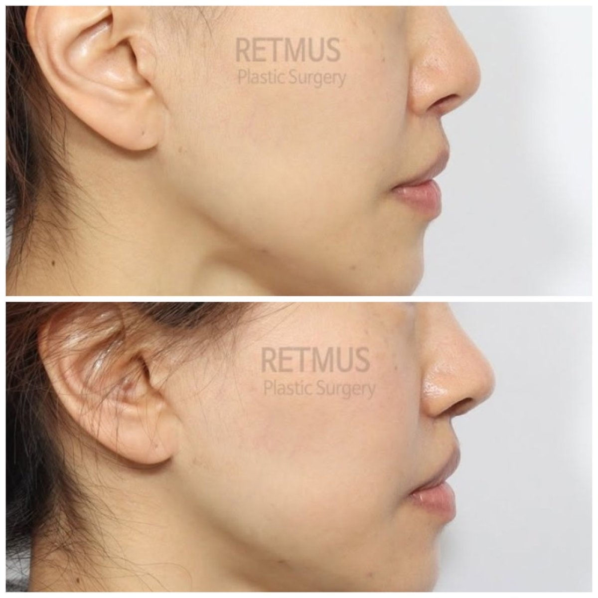 نتائج قبل وبعد عملية تجميل الأنف التصحيحية في Retmus Plastic Surgery، تحسين شكل الأنف