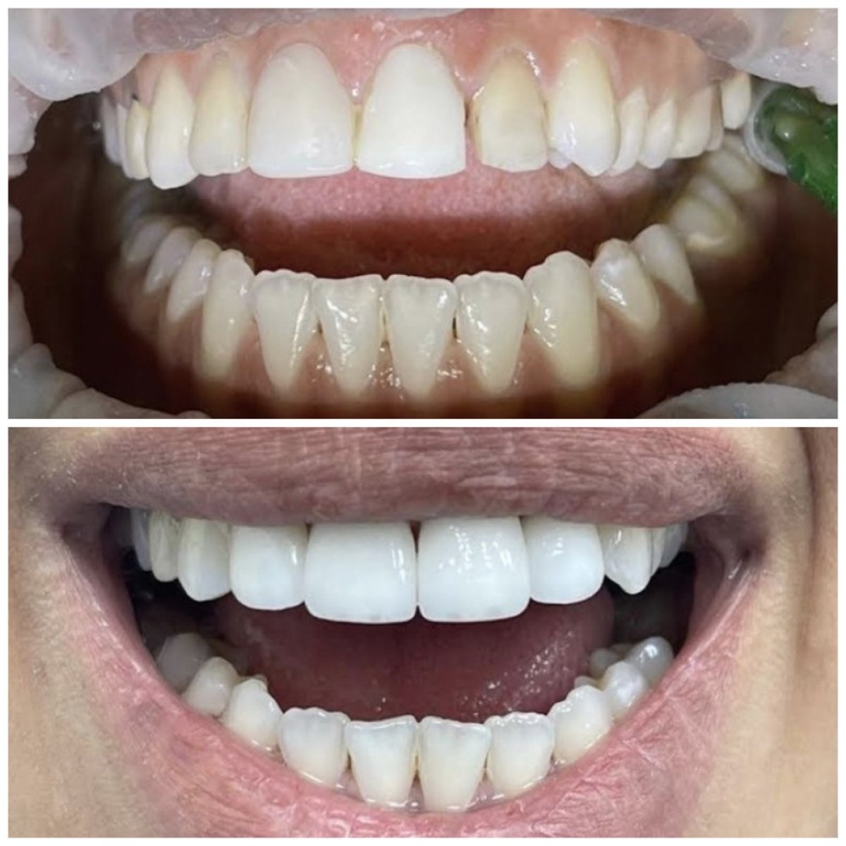 Antes y después de la colocación de coronas dentales en Richter's Clinic – mejora visible de la sonrisa