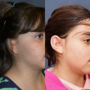 before-after photo rekonstrukcia-usnoj-rakoviny