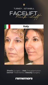 Resultados de minilifting facial antes y después en Memorial Göztepe Hospital, rejuvenecimiento