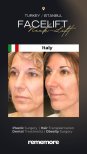 Resultados de minilifting facial antes y después en Memorial Göztepe Hospital, rejuvenecimiento