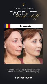 Resultados de minilifting facial antes y después en Memorial Göztepe Hospital, rejuvenecimiento facial