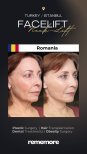 Resultados de minilifting facial antes y después en Memorial Göztepe Hospital, rejuvenecimiento facial