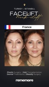 Resultados de minilifting facial antes y después en Memorial Göztepe Hospital, rejuvenecimiento facial