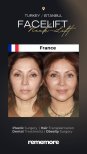 Resultados de minilifting facial antes y después en Memorial Göztepe Hospital, rejuvenecimiento facial