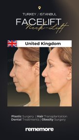 Resultados de minilifting facial antes y después en Memorial Göztepe Hospital, efecto cuello