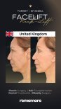 Resultados de minilifting facial antes y después en Memorial Göztepe Hospital, efecto cuello