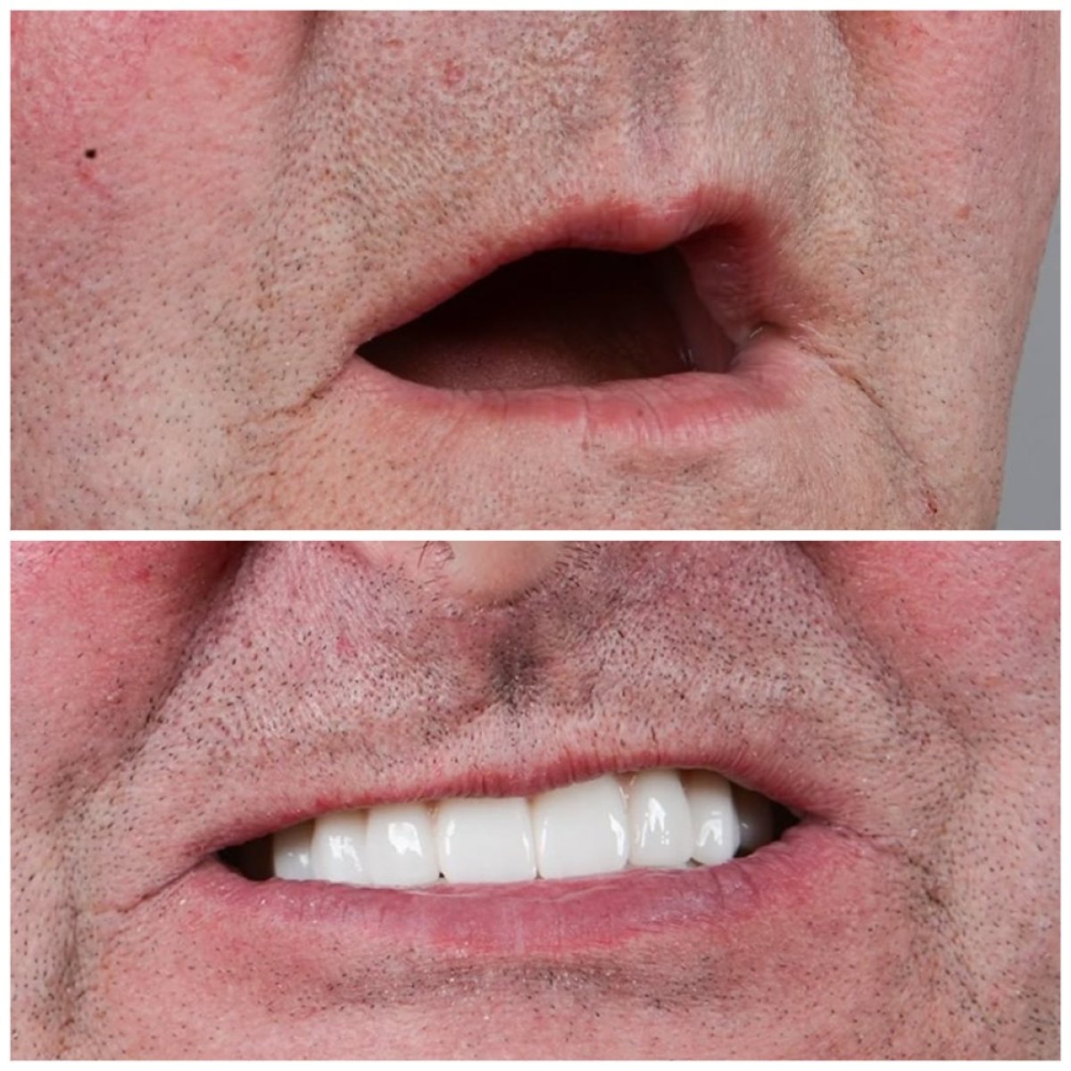 Resultado antes y después de prótesis de zirconia en Uncali Dental Clinic