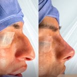 نتيجة عملية تجميل الأنف قبل وبعد في Lucio Santos Plastic Surgery، إعادة تشكيل الأنف