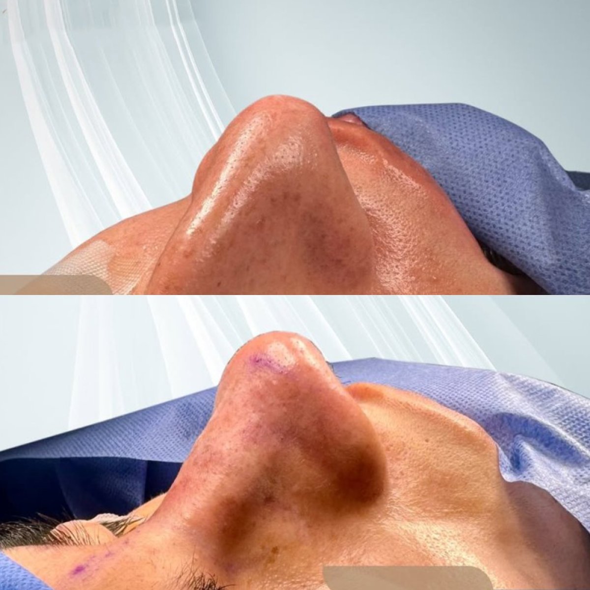 Resultados de rinoplastia antes y después en Lucio Santos Plastic Surgery, perfil nasal mejorado