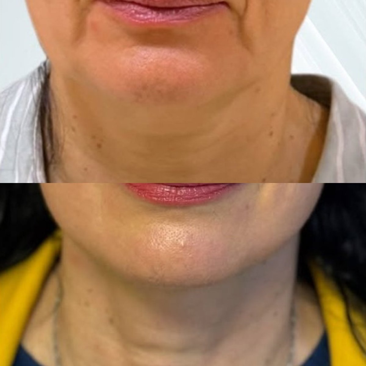 نتائج شد الرقبة قبل وبعد في Lucio Santos Plastic Surgery، تحسين محيط الرقبة