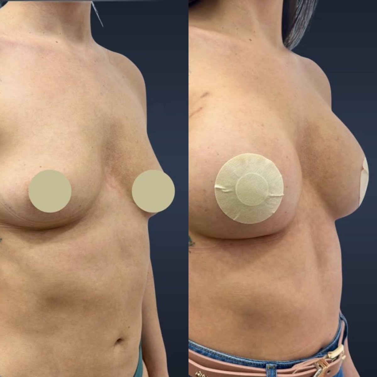Antes y después de aumento de senos en Lucio Santos Plastic Surgery, resultado de mayor volumen