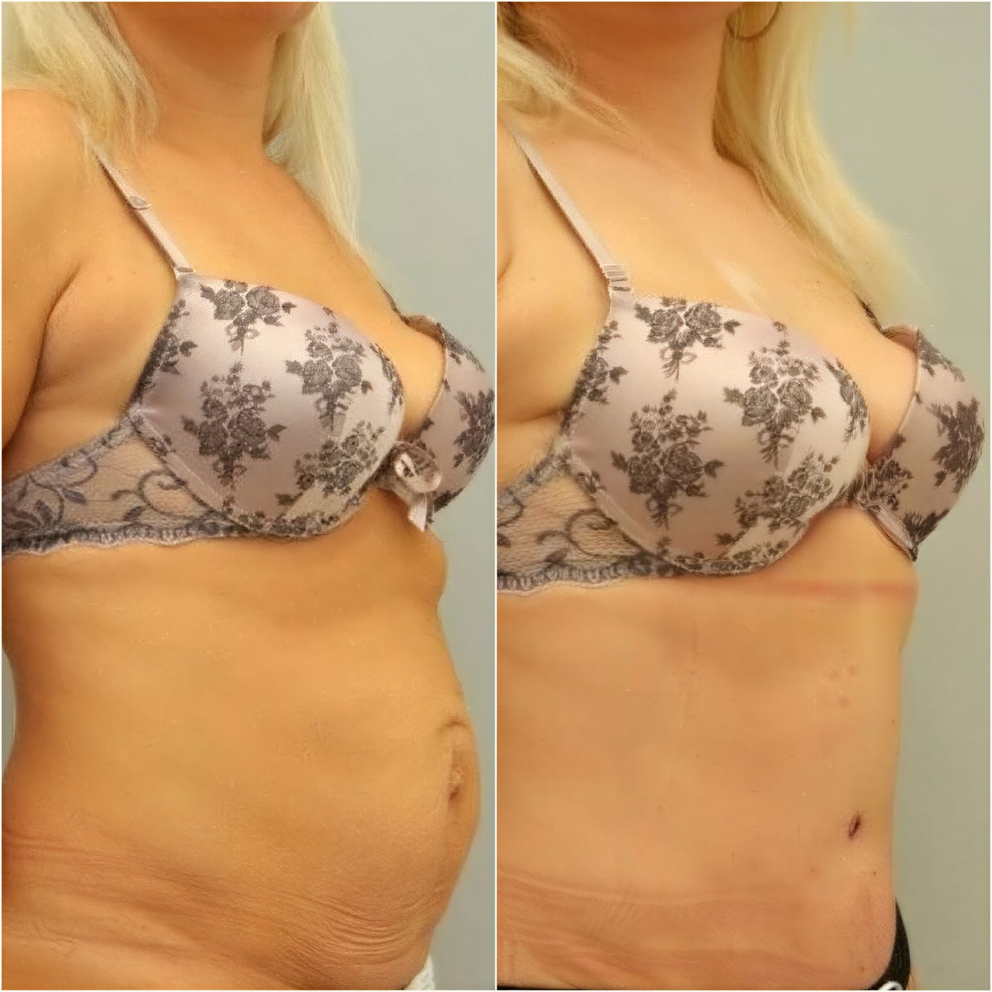 Resultados de abdominoplastia antes y después en Clinicus Klaipeda – abdomen más plano