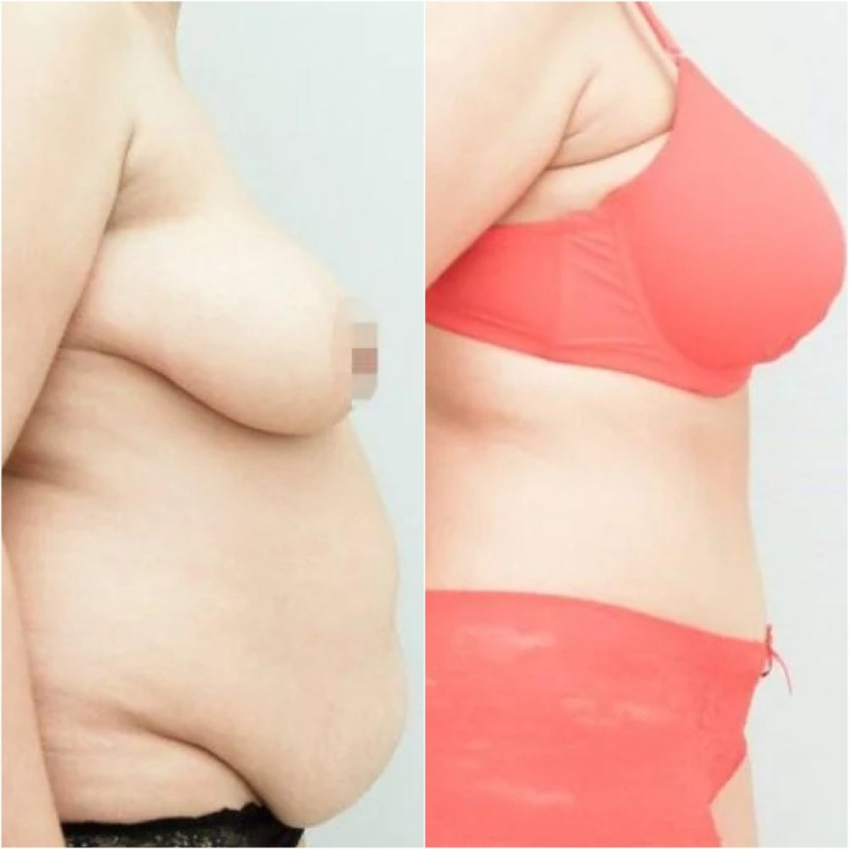 Resultados de abdominoplastia antes y después en Clinicus Klaipeda, mejora del contorno abdominal