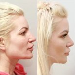 Resultados de rinoplastia antes y después en Clinicus Klaipeda, perfil y contorno nasal mejorados