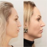 Resultados de rinoplastia antes y después en Clinicus Klaipeda, perfil nasal mejorado