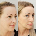 Resultados de rinoplastia antes y después en Clinicus Klaipeda, mejora de forma y perfil nasal