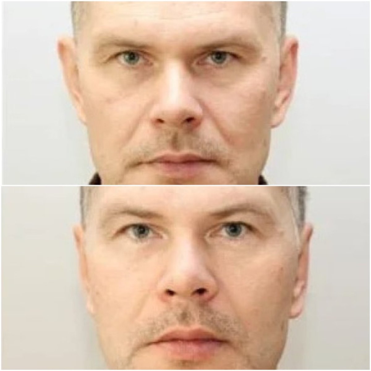 Resultados de otoplastia antes y después en Clinicus Klaipeda, mejora de forma y simetría