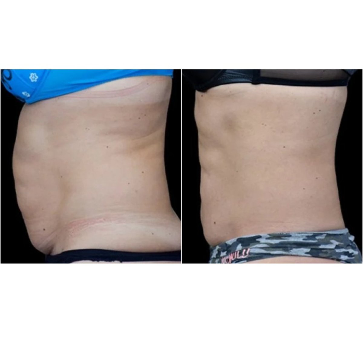Resultados de liposucción antes y después en Clinicus Klaipeda: abdomen más delgado