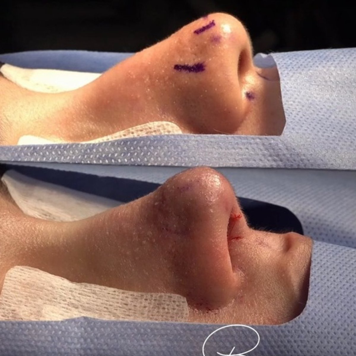 نتائج قبل وبعد عملية تجميل الأنف في Bizrahmed، تحسين واضح لشكل الأنف