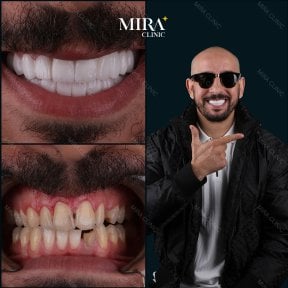 Результат до и после установки зубного моста в Mira Clinic, заметное преображение улыбки