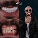 Результат до и после установки зубного моста в Mira Clinic, заметное преображение улыбки