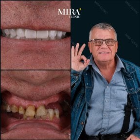 До и после установки зубного моста в Mira Clinic, восстановленная улыбка и результат
