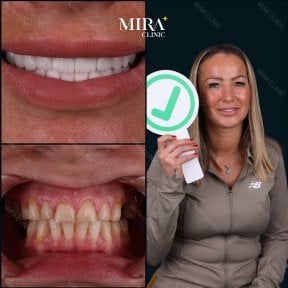 Результаты до и после установки зубного моста в Mira Clinic, улучшенная улыбка