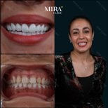 Resultados antes y después de coronas de zirconio en Mira Clinic, sonrisa más blanca