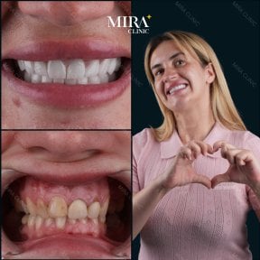 Resultados antes y después de coronas de zirconia en Mira Clinic, sonrisa y estética mejoradas