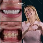 Resultados antes y después de coronas de zirconia en Mira Clinic, sonrisa y estética mejoradas