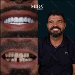 Resultados antes y después de coronas de zirconio en Mira Clinic, sonrisa natural